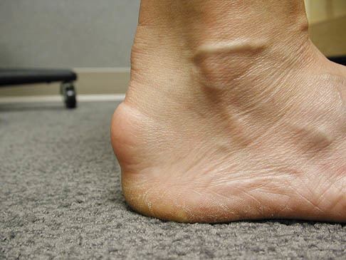 Achilles Tendonitis On Foot
